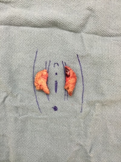 Vaginal mutilation — 8